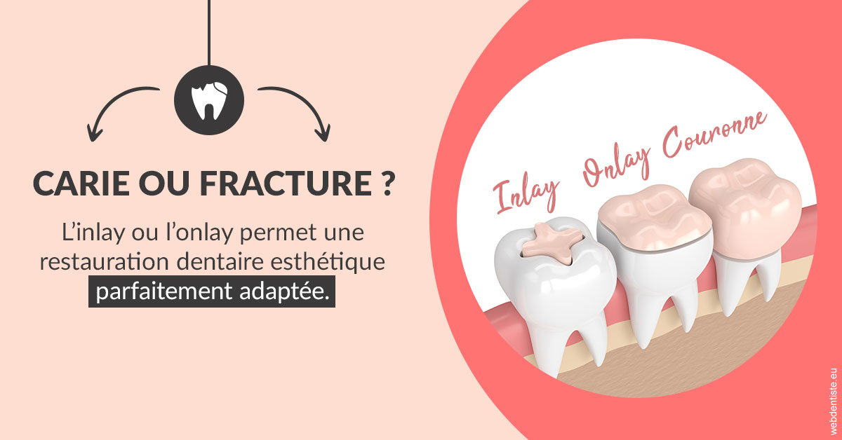 https://www.dentiste-de-chaumont.fr/T2 2023 - Carie ou fracture 2