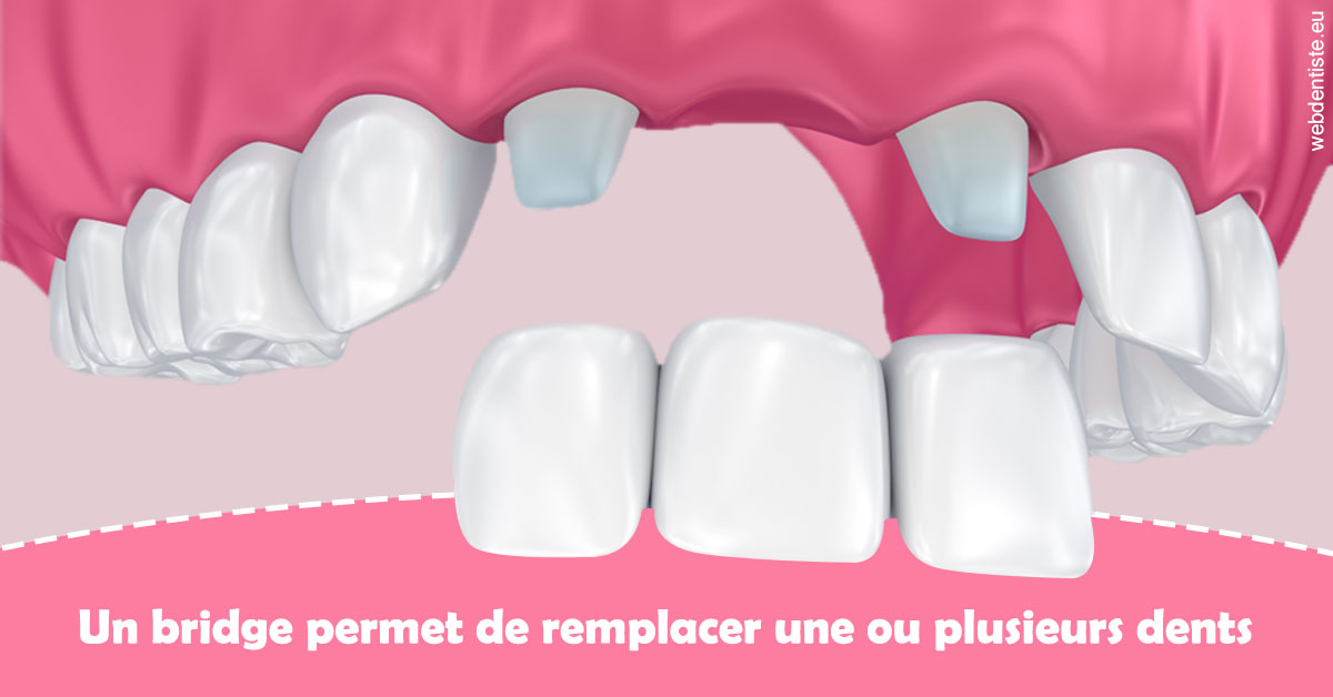 https://www.dentiste-de-chaumont.fr/Bridge remplacer dents 2