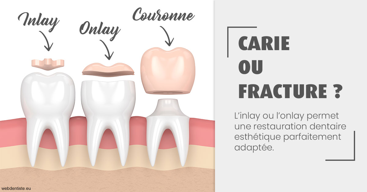 https://www.dentiste-de-chaumont.fr/T2 2023 - Carie ou fracture 1