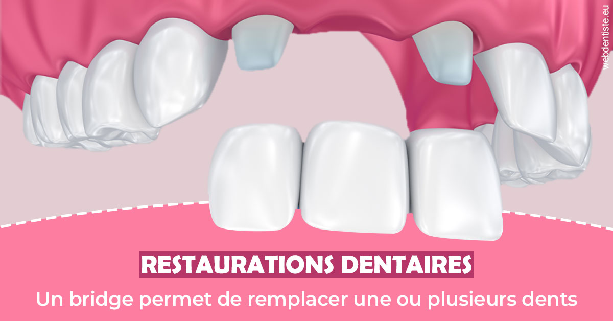 https://www.dentiste-de-chaumont.fr/Bridge remplacer dents 2