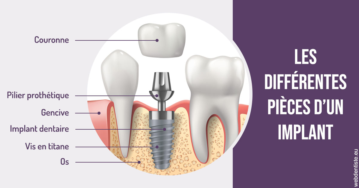 https://www.dentiste-de-chaumont.fr/Les différentes pièces d’un implant 2