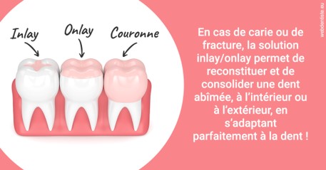 https://www.dentiste-de-chaumont.fr/L'INLAY ou l'ONLAY 2