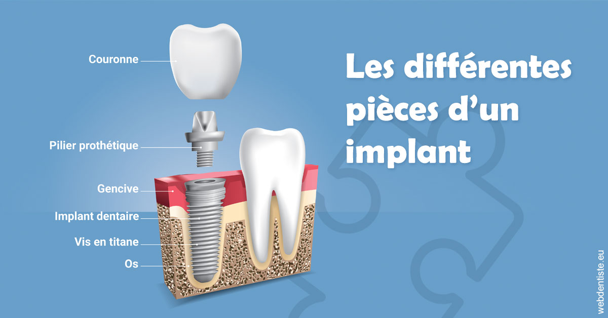 https://www.dentiste-de-chaumont.fr/Les différentes pièces d’un implant 1